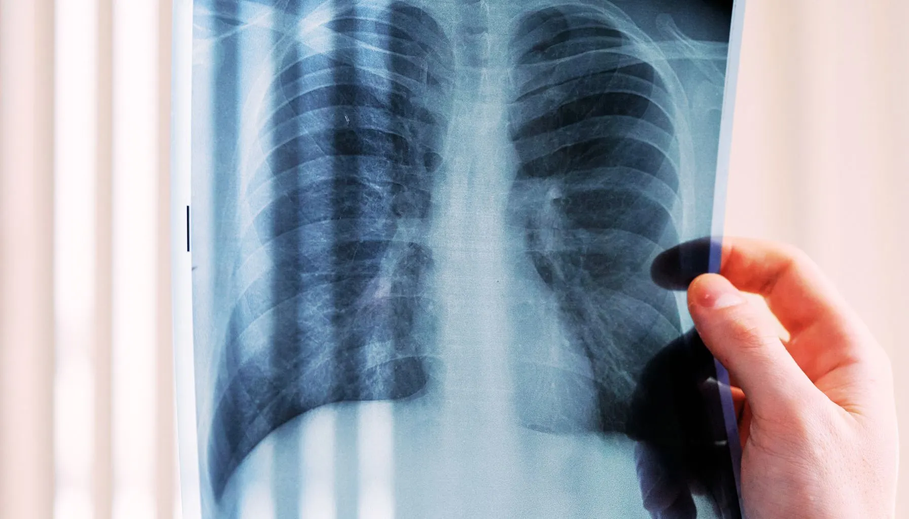 El Supremo reitera doctrina sobre la incapacidad total por silicosis y no exige limitación respiratoria grave